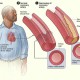 cardiovascular system disease