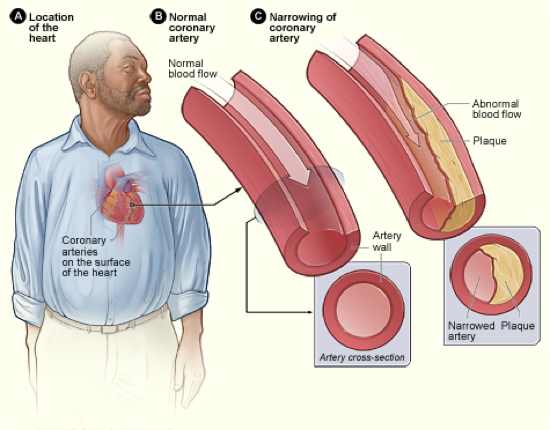 cardiovascular system disease