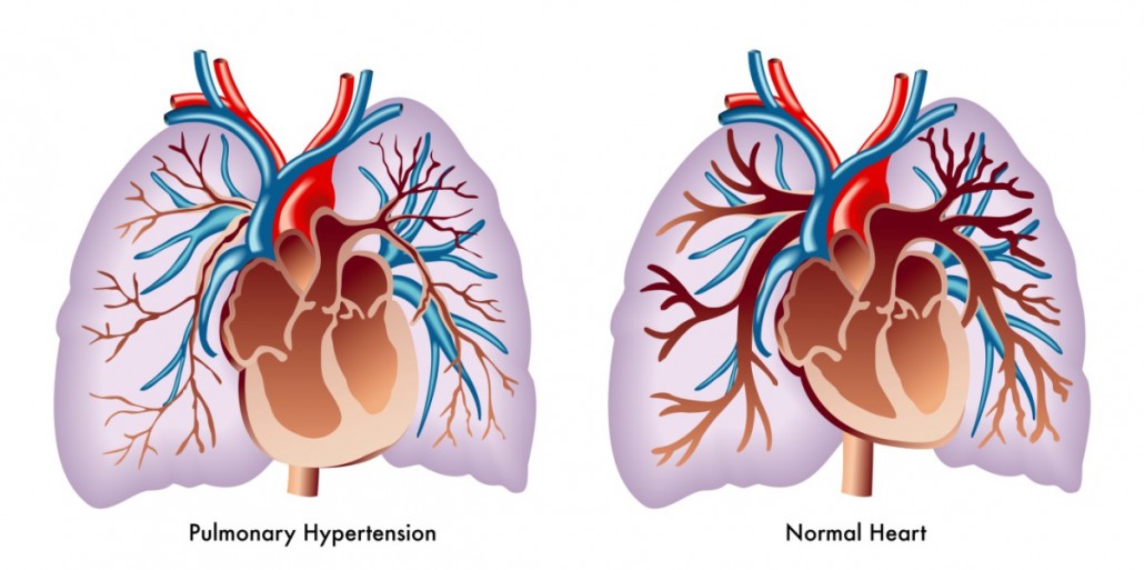 Viagra And PAH Pulmonary arterial hypertension