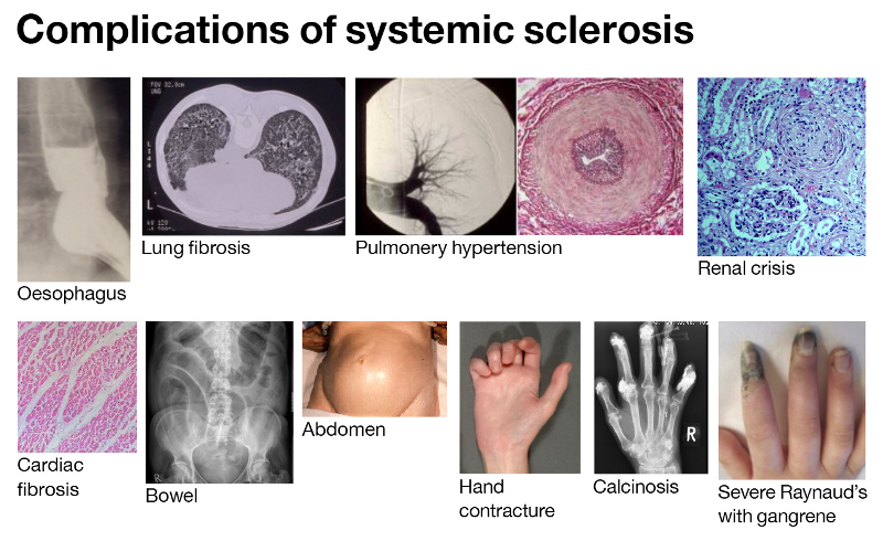 Viagra Benefits In Digital Ulcer Systemic sclerosis or scleroderma