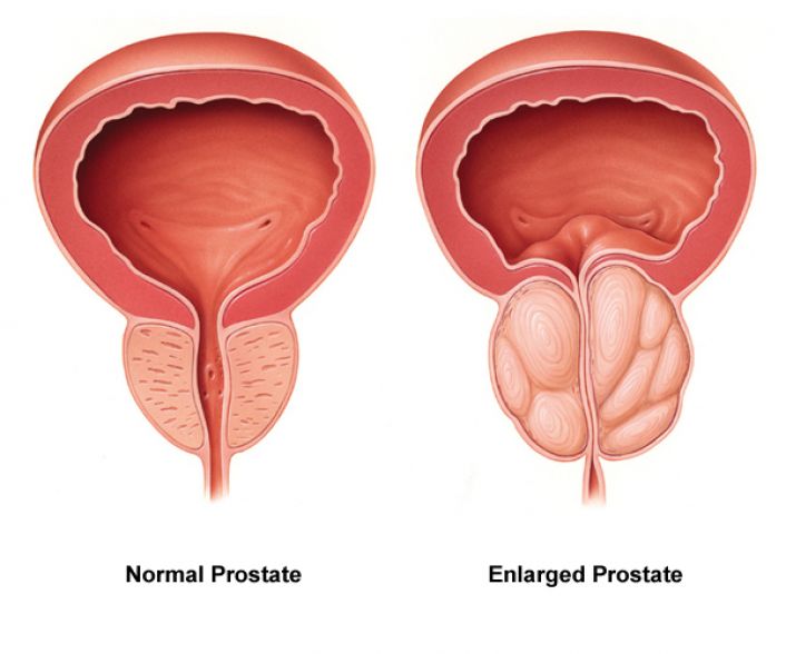 Patients with Benign Prostatic Hyperplasia