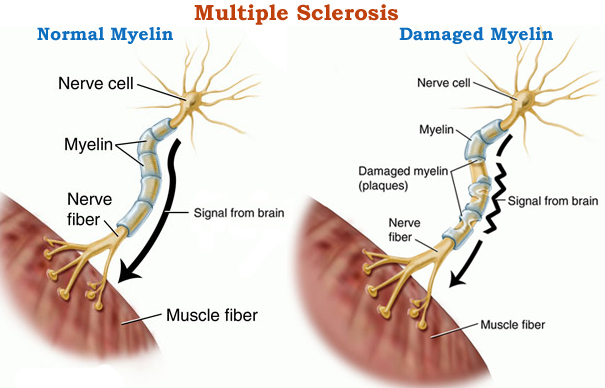 Viagra In Multiple Sclerosis Effects Multiple sclerosis