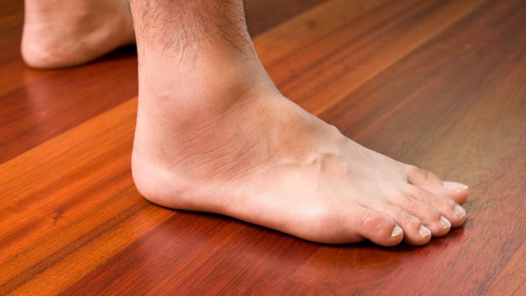 swollen-ankles