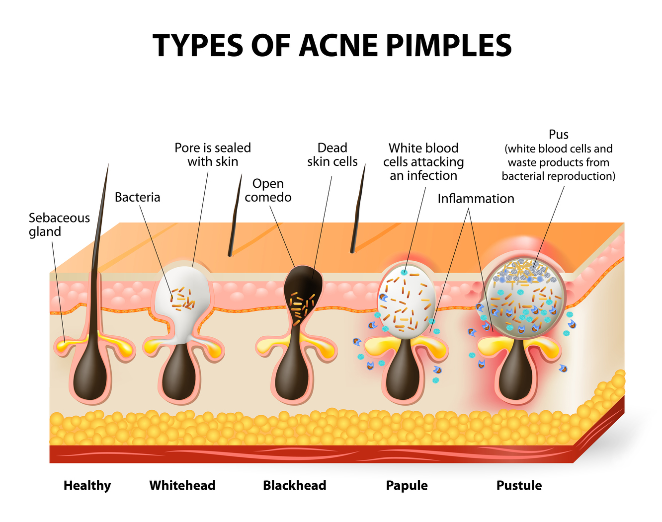 How is acne formed