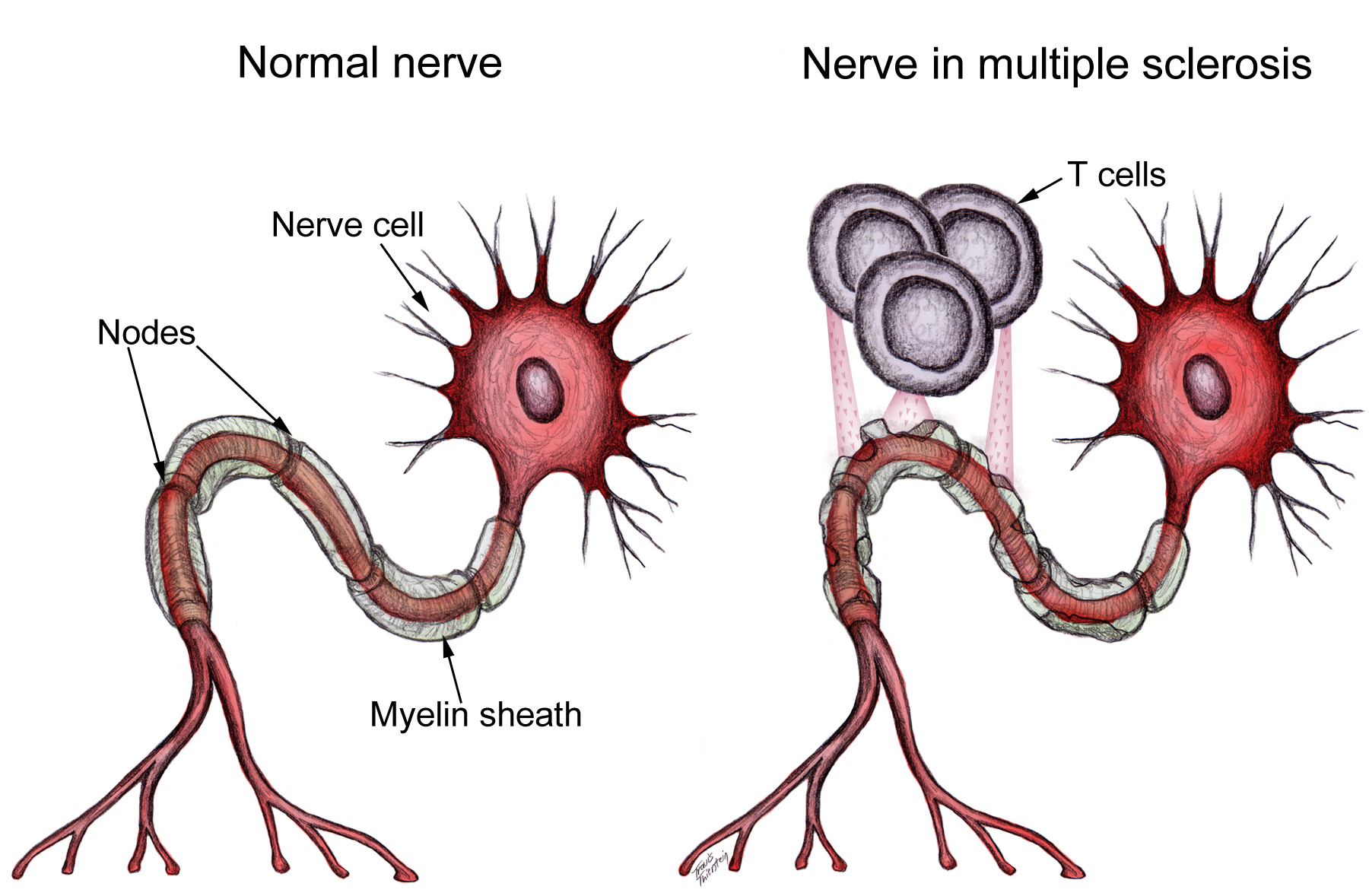 Sclerosis