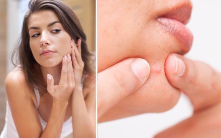 acne tips