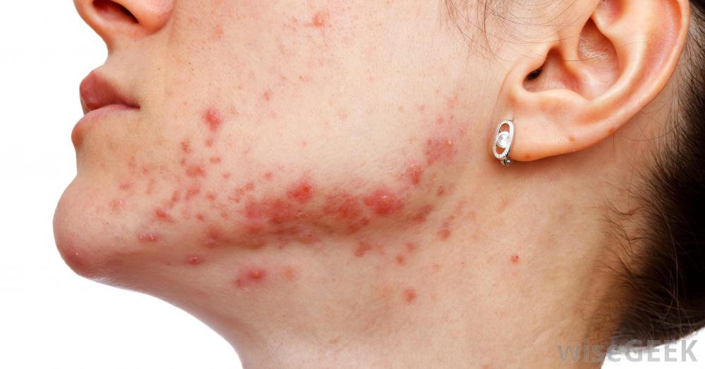 Accutane 10 mg Contre Indication