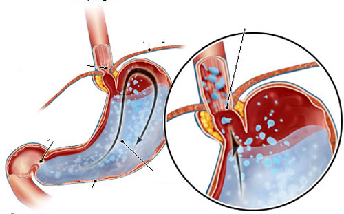 reflux oesophagitis