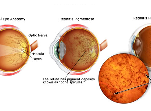 Erectile-Dysfunction-in-Patients-with-Retinitis-Pigmentosa