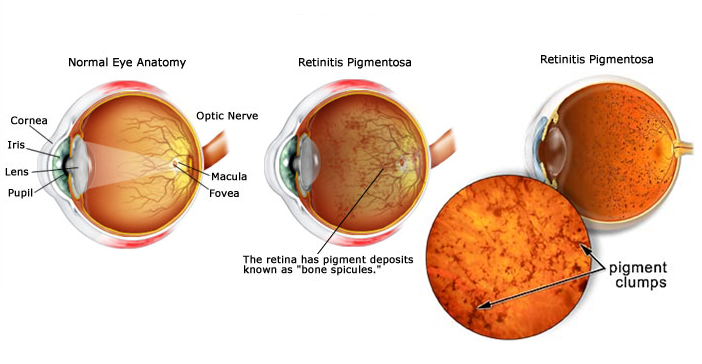 Erectile-Dysfunction-in-Patients-with-Retinitis-Pigmentosa