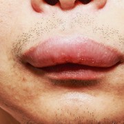 Cialis Viagra And Angioedema A Side Effect You Should Not Neglect