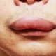 Cialis Viagra And Angioedema A Side Effect You Should Not Neglect