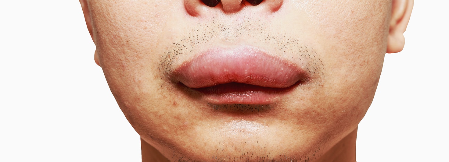 Cialis Viagra And Angioedema A Side Effect You Should Not Neglect