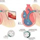 What is pulmonary arterial hypertension?