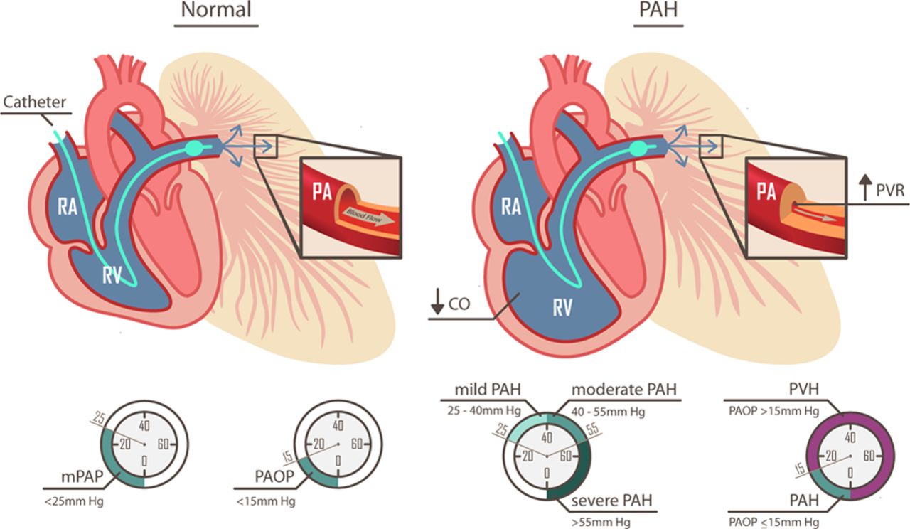 What is pulmonary arterial hypertension?