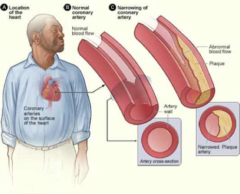 cardiovascular system disease