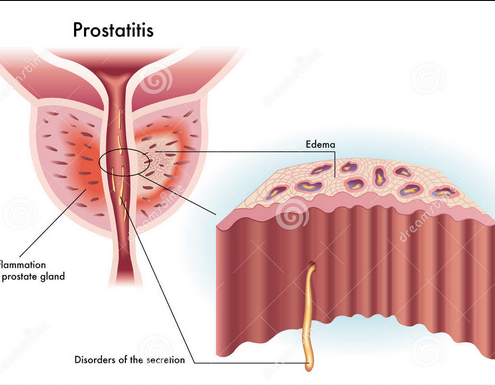 Attacking all the male age groups bizarrely. Prostatitis.