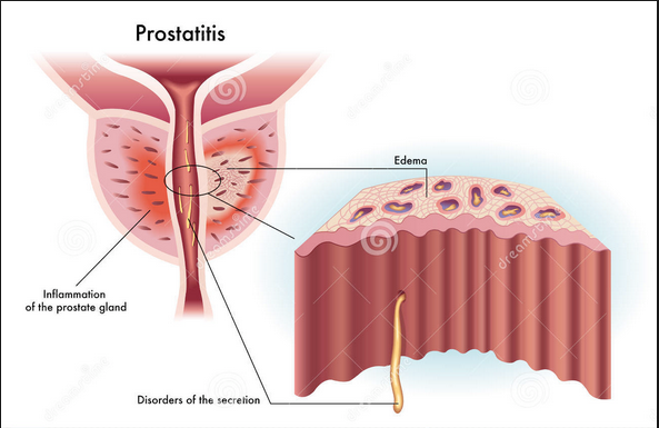 Attacking all the male age groups bizarrely. Prostatitis. 