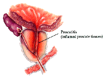 acute prostatitis