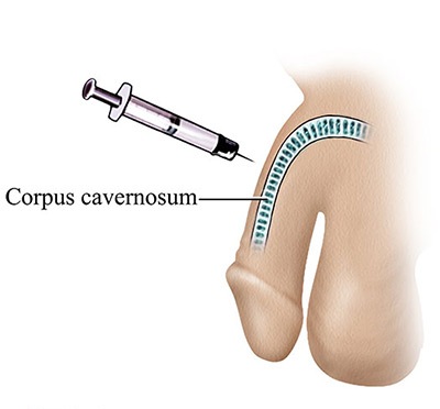 injection