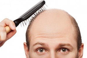 male-pattern-baldness