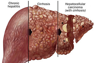 Hepatitis B