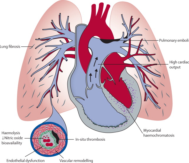 PULMONARY HYPERTENSION