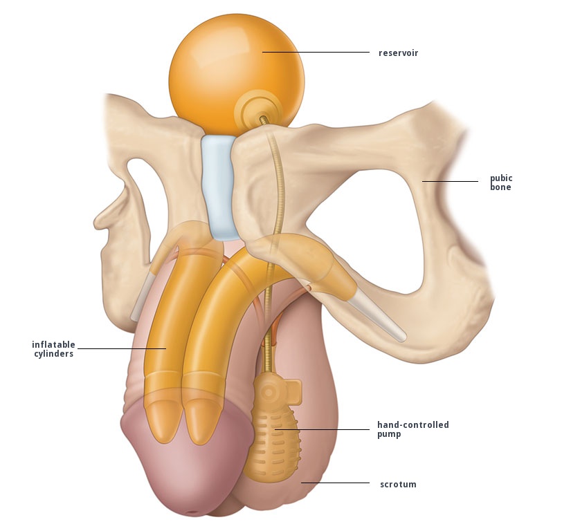 Introduction to penile implants