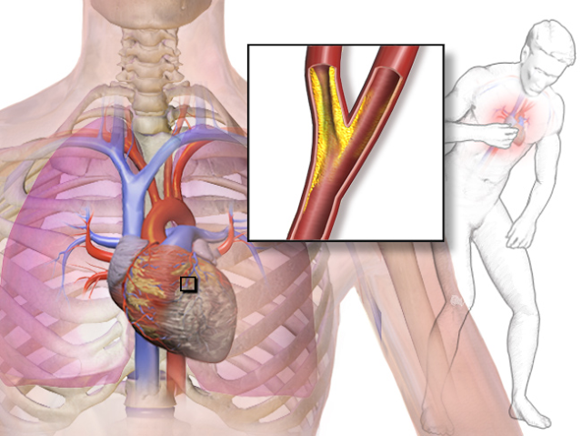 Nitroglycerin Vs Cardiac Angina