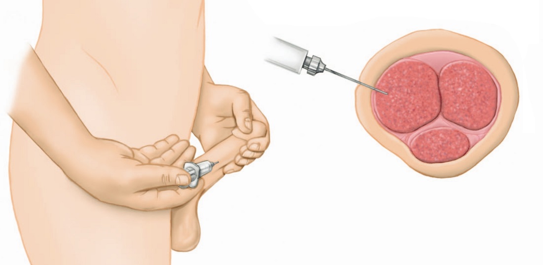 How Does Alprostadil Work in the Form of Injections