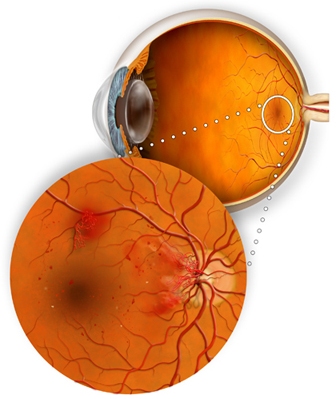 Retinitis Pigmentosa-Etiology, Symptoms, Treatment and On-Going Research
