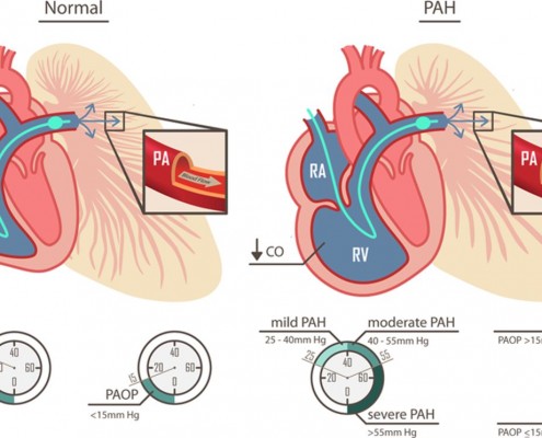 What is pulmonary arterial hypertension?